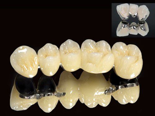 Răng sứ kim loại Titan 