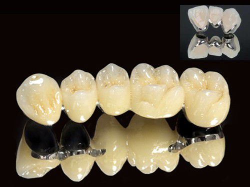 Răng sứ kim loại Titan