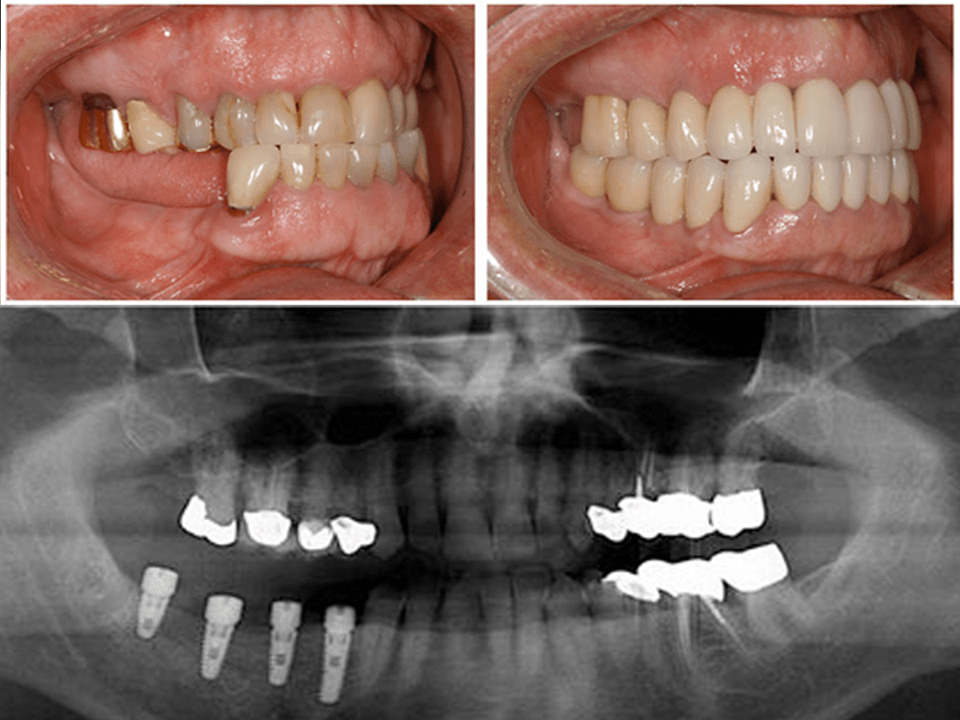 Thời gian cấy ghép Implant là bao lâu