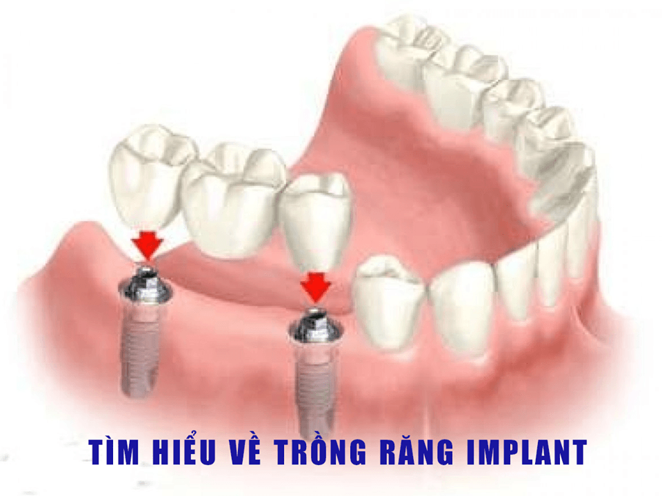 Cấy ghép implant có đau không