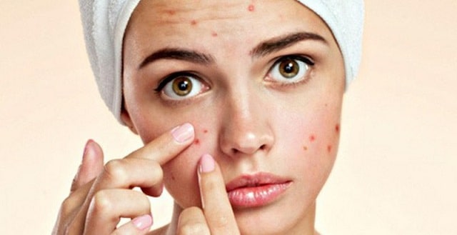 lựa chọn dòng kem trị mụn phù hợp