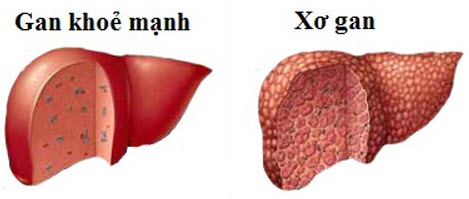 Hình ảnh tìm hiểu về xơ gan - nguyên nhân và cách điều trị xơ gan