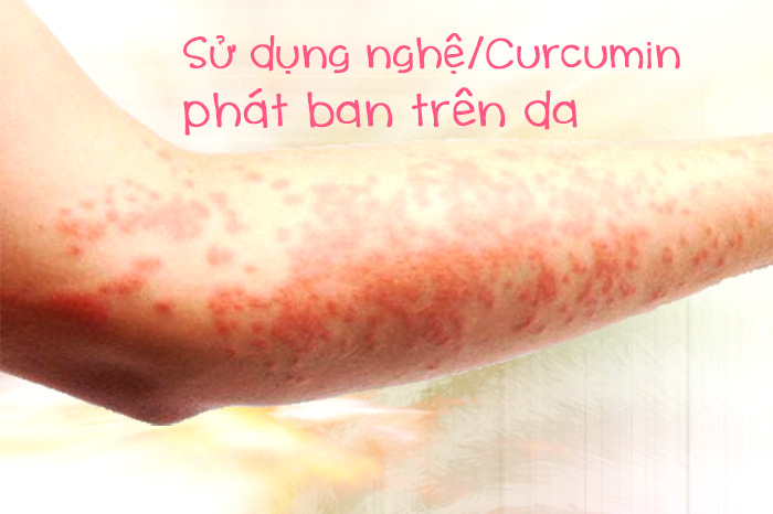 công dụng phụ của bột nghệ có thể gây phát ban da