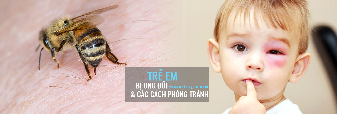 trẻ bị ong đốt