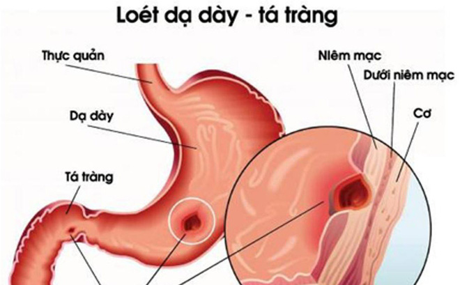 Có 2 dấu hiệu này vết loét dạ dày có thể đang tiến triển thành ung thư