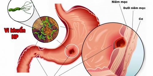 Bệnh đau dạ dày nguyên nhân và cách điều trị