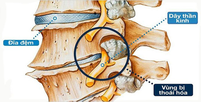 Thoái hóa cột sống - nguồn gốc các bệnh xương khớp