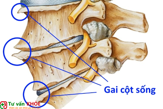 Nguyên nhân và cách điều trị bệnh gai cột sống