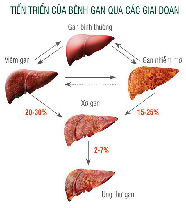 Bệnh gan nhiễm mỡ là tiền đề dẫn đến xơ gan, ung thư gan