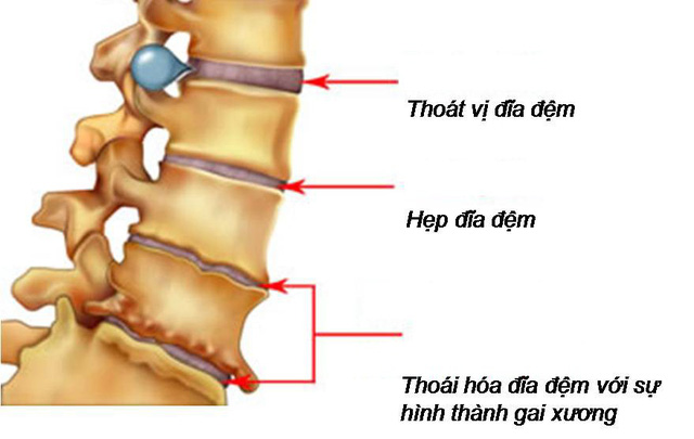 Thoái hóa cột sống ở người già và cách chữa