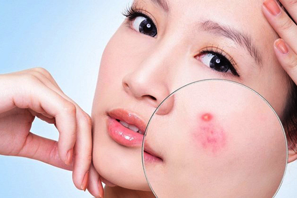 Rượu cây mật gấu giúp trị mụn và xóa vết thâm mụn hiệu quả