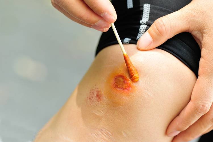 Sát khuẩn vết thương Betadine