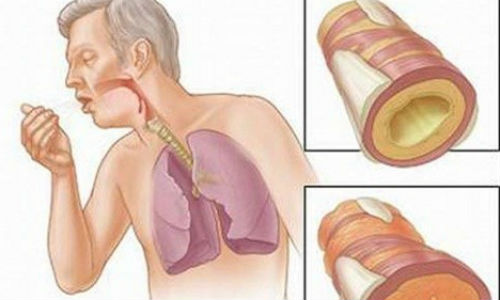 Đông trùng hạ thảo hỗ trợ điều trị bệnh phổi hiệu quả