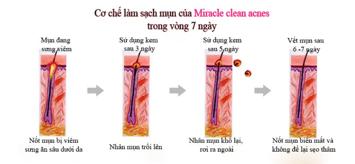 KEM SẠCH MỤN TẬN GỐC GLUTA WHITE - 11