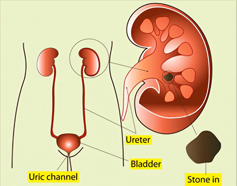 types of urinary stones