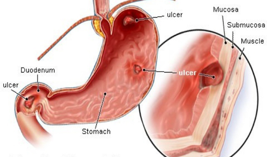 Biểu hiện của bệnh ung thư tá tràng