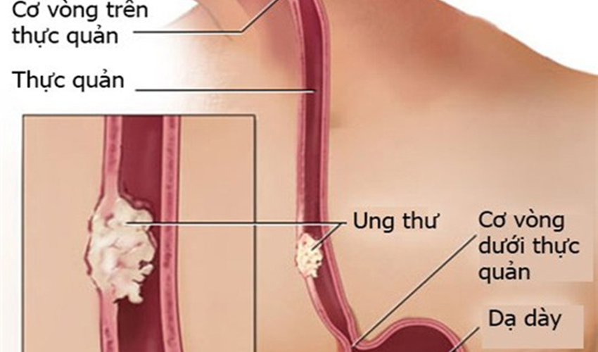 CÁCH NHẬN BIẾT UNG THƯ THỰC QUẢN