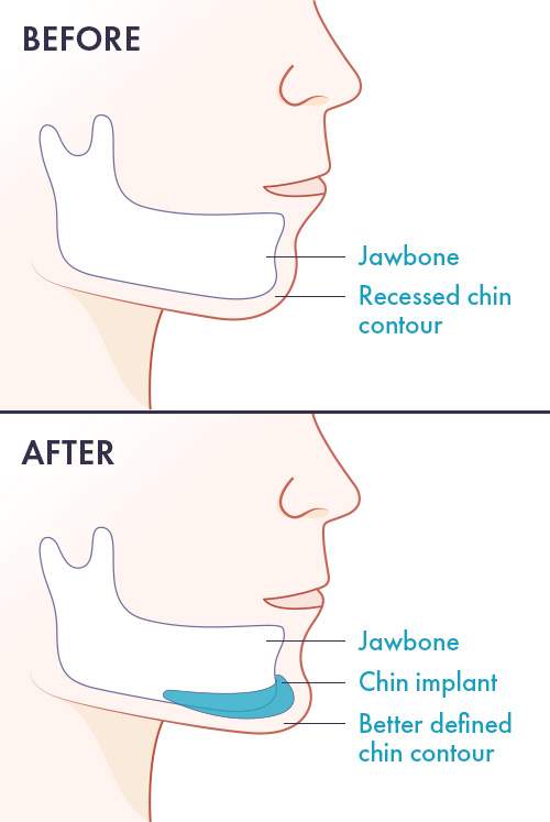 Các kỹ thuật chỉnh sửa cằm lẹm