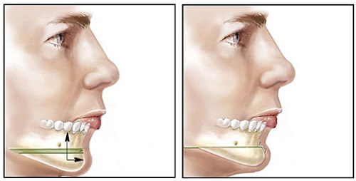 Kỹ thuật độn cằm xương tự thân và ưu điểm của kỹ thuật độn cằm xương tự thân