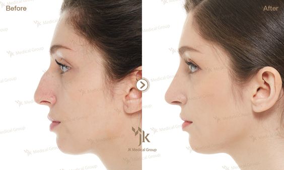 Các loại sụn tự thân trong phẫu thuật thẩm mỹ mũi
