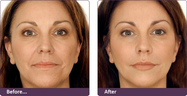 Những điều cần lưu ý trước khi tiêm botox