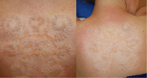 Chế độ chăm sóc sau khi xóa xăm bằng laser