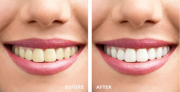 Chăm sóc sau khi tẩy trắng răng thế nào để duy trì kết quả lâu dài?