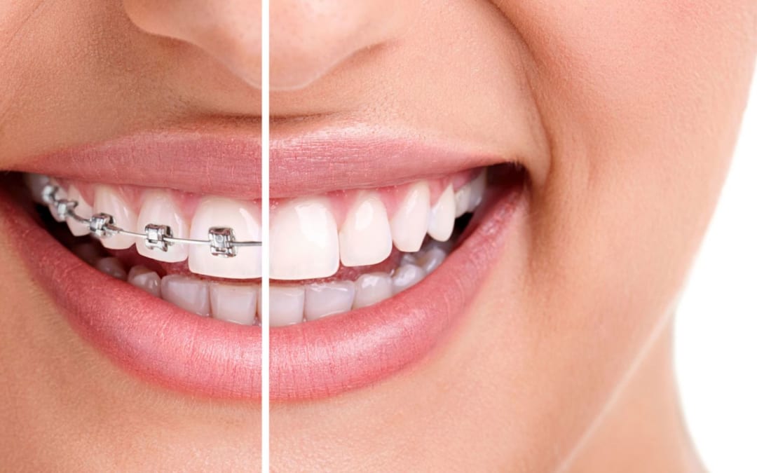 Nhiều trường hợp cần niềng răng bao gồm cả thẩm mỹ, khắc phục