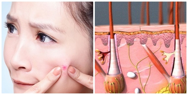 Tác hại của thói quen nặn mụn