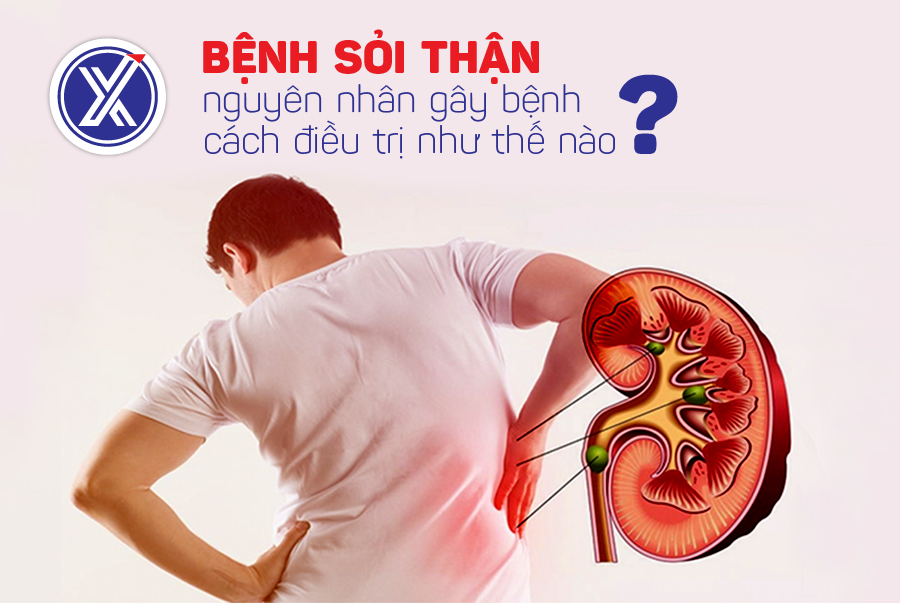 BỆNH SỎI THẬN – NGUYÊN NHÂN GÂY BỆNH VÀ CẦN ĐIỀU TRỊ NHƯ THẾ NÀO?