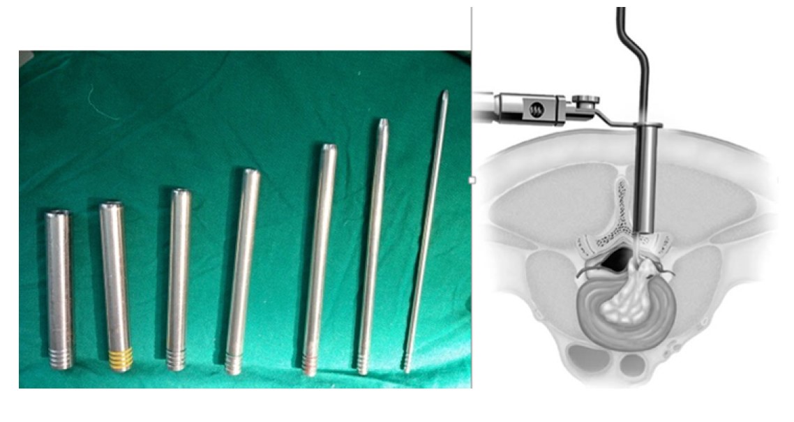 thoát vị đĩa đệm thắt lưng