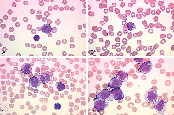 Ăn gì để tăng lượng bạch cầu trong máu ở bệnh nhân ung thư