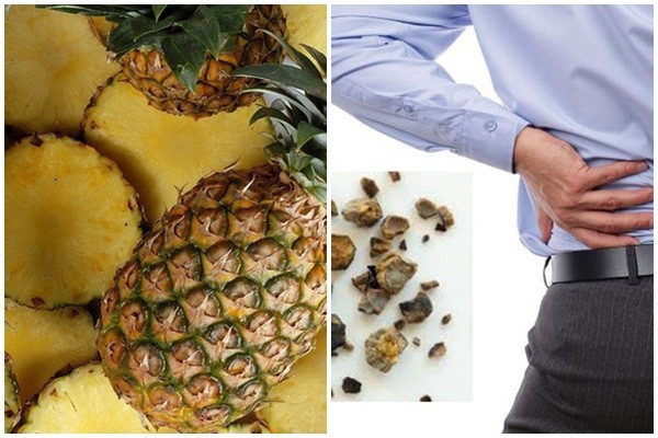 Bài thuốc trị sỏi thận hiệu quả an toàn nhất