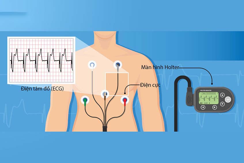 Bệnh cơ tim loạn nhịp thất phải