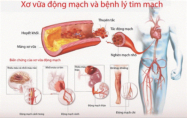 Bệnh mạch vành có chữa được không và cách phòng bệnh ra sao
