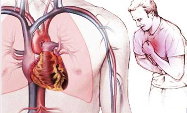 Bệnh mạch vành có nguy hiểm không và cách phòng bệnh ra sao