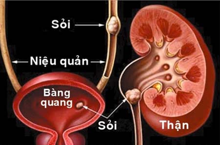 Bệnh sỏi thận nguyên nhân, triệu chứng và cách điều trị sỏi thận