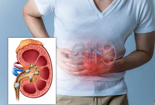 Bệnh sỏi thận ở người cao tuổi nguyên nhân và cách điều trị