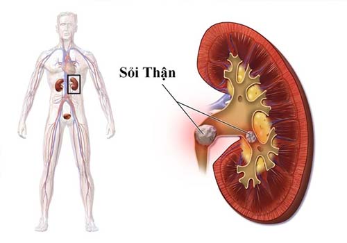 bệnh sỏi thận và cách điều trị như thế nào