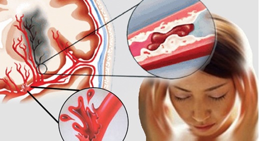 Bệnh tai biến mạch máu não là gì