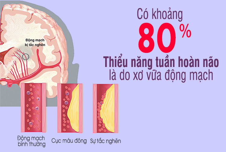 Bệnh thiểu năng tuần hoàn não có chữa được không