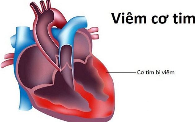 Bệnh viêm cơ tim có chữa khỏi được không và cách điều trị ra sao