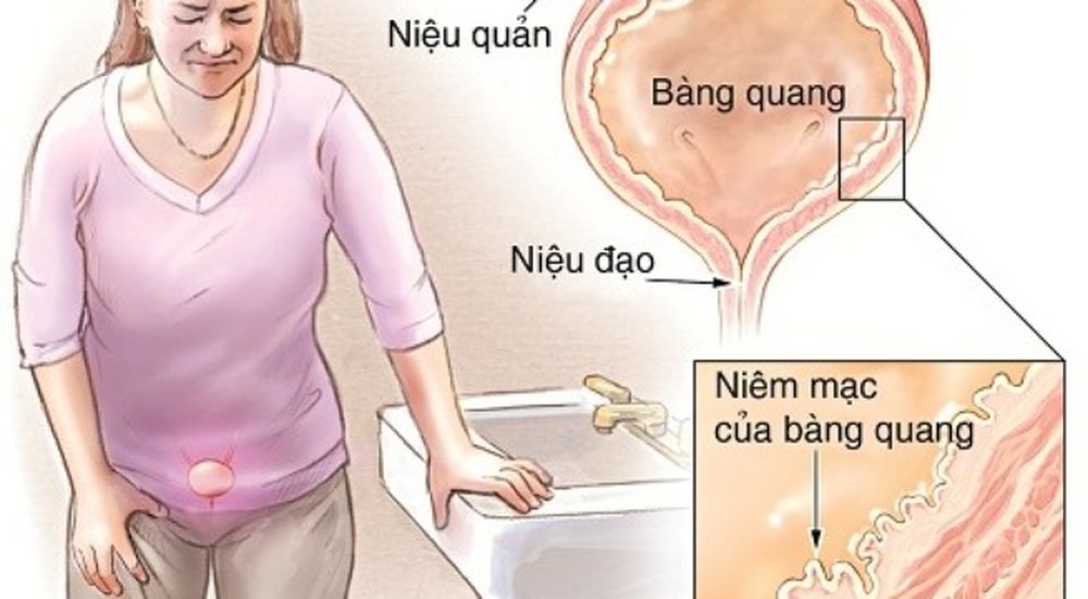 Bệnh viêm đường tiết niệu ở nữ giới và cách phòng bệnh như thế nào