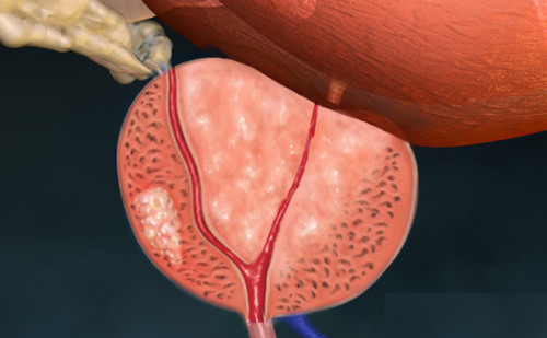 Bệnh viêm tuyến tiền liệt ở nam giới là gì