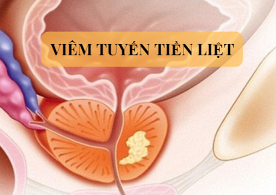 Triệu chứng viêm tuyến tiền liệt ở nam giới như thế nào