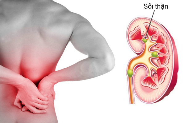 Người bị sỏi thận uống gì