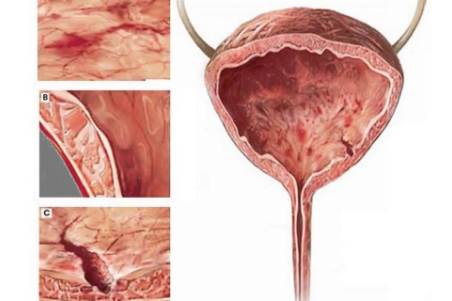 Biểu hiện của viêm đường tiết niệu là gì và cách phòng bệnh ra sao