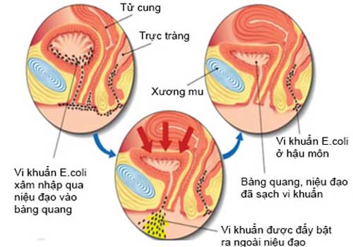 Biểu hiện viêm tuyến tiền liệt là gì và cách khắc phục ra sao