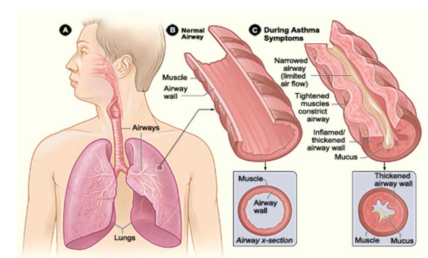 CẬP NHẬT ĐIỀU TRỊ HEN PHẾ QUẢN