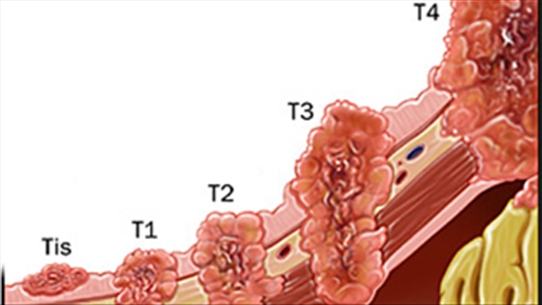 Các giai đoạn của ung thư dạ dày như thế nào